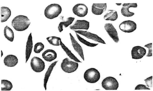 (Image of magnified blood smear)